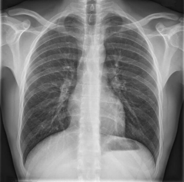 Osteochondrosis of the thoracic spine is diagnosed by x-ray.