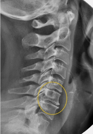 Osteochondrosis of the cervical column in an x ​​line