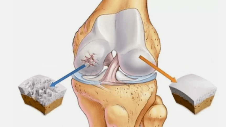 How osteoarthritis develops