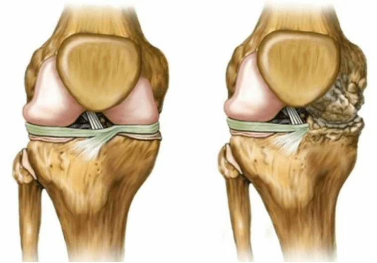 Stages of osteoarthritis