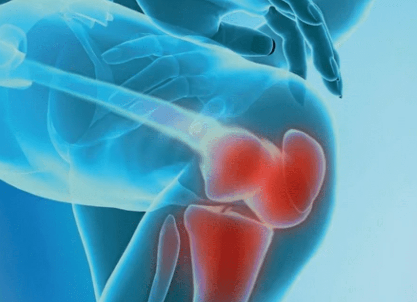 What is osteoarthritis