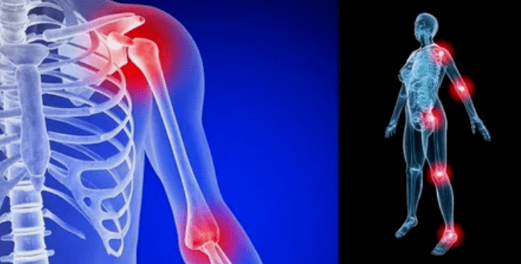 limb deformation for osteoarthritis