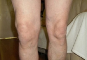 manifestations of osteoarthritis of the knee joint (1)