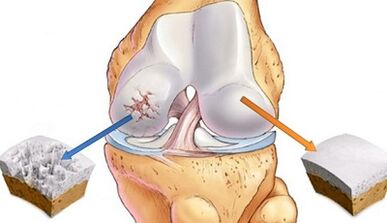 causes of osteoarthritis of the joints