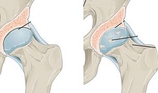 developmental stages of hip osteoarthritis