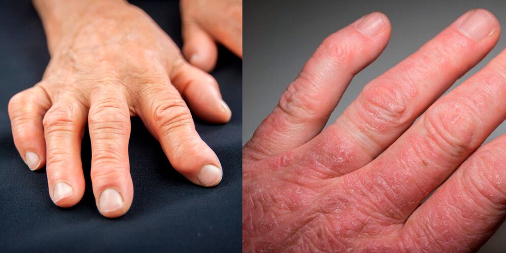 rheumatoid and psoriatic arthritis of the hands