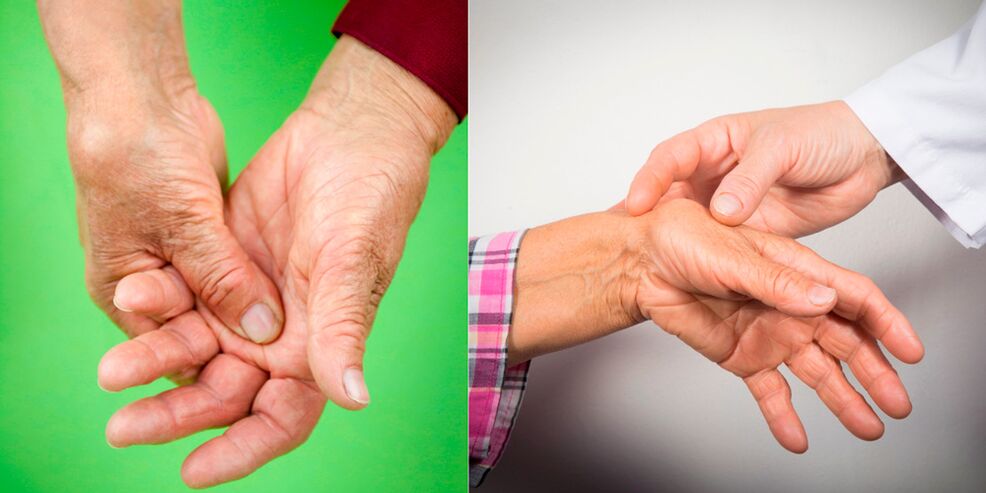 swelling and pain are the first signs of arthritis of the hand