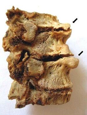 Vertebral section affected by osteochondrosis