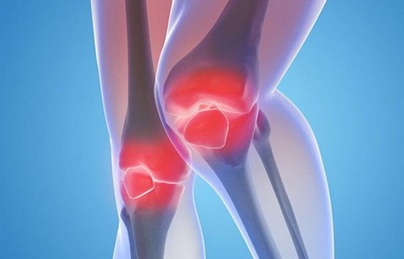 osteoarthritis of the knee joints
