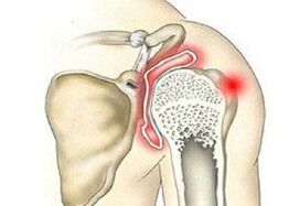 destruction of the shoulder joint with arthrosis