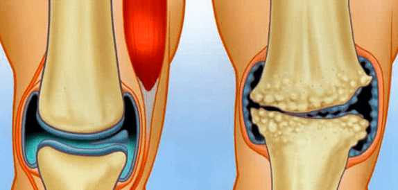 Normal articulation and osteoarthritis